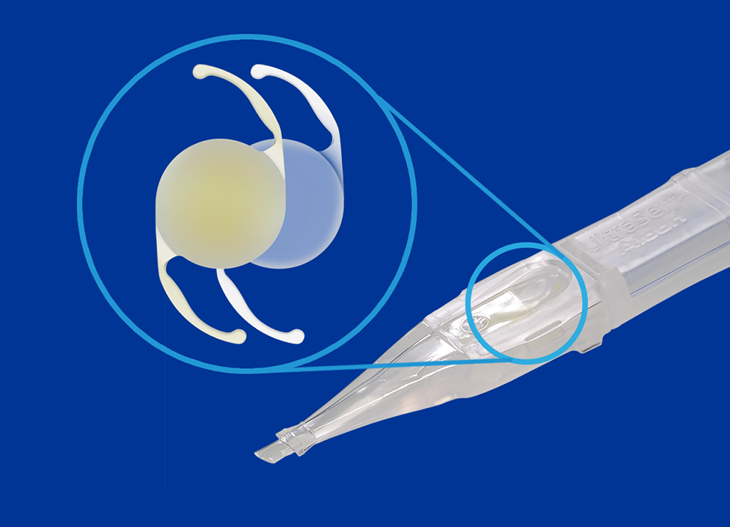 Sistema inyector precargado UltraSert con un círculo sobre el dispositivo para indicar dónde introduciría la LIO AcrySof IQ. A la izquierda del sistema inyector hay un primer plano tridimensional de dos LIOs.