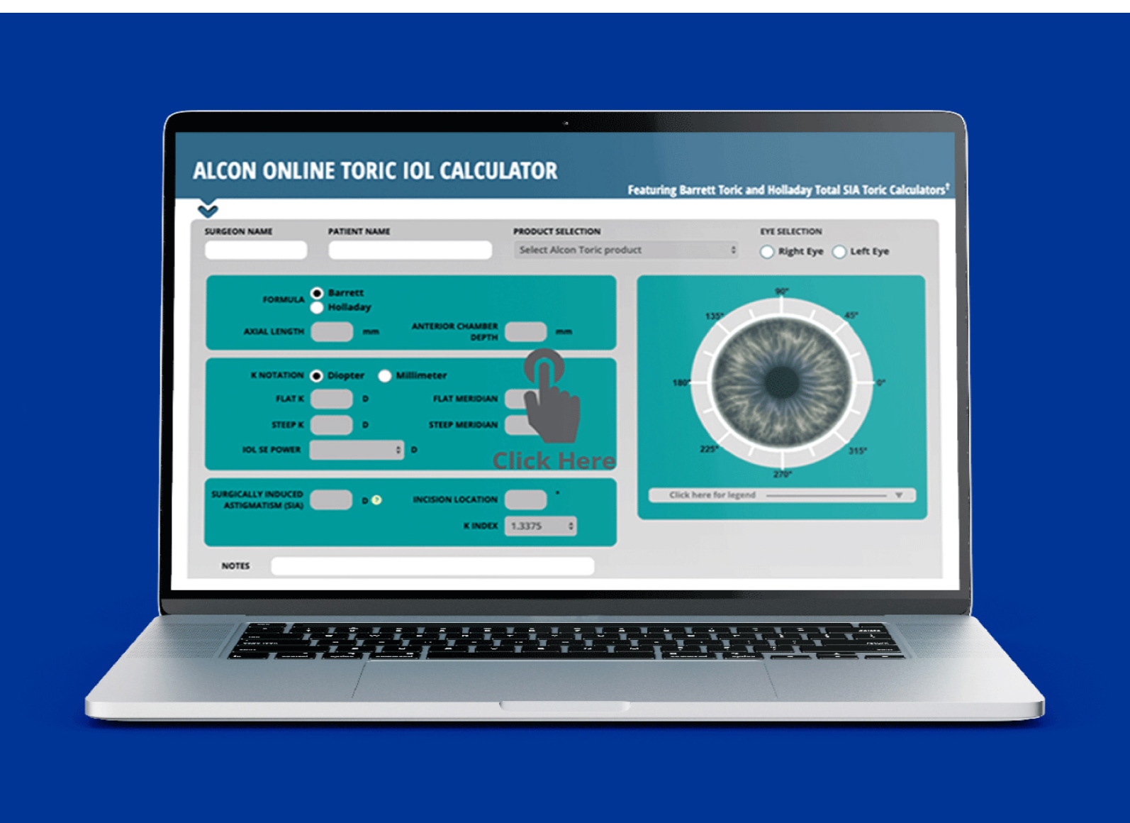 Ordenador portátil abierto con la calculadora online de LIOs tóricas de Alcon en la pantalla.