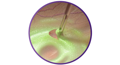 Close-up van de SHARKSKIN ILM Forceps die weefsel vastgrijpt om het pelvermogen te demonstreren.